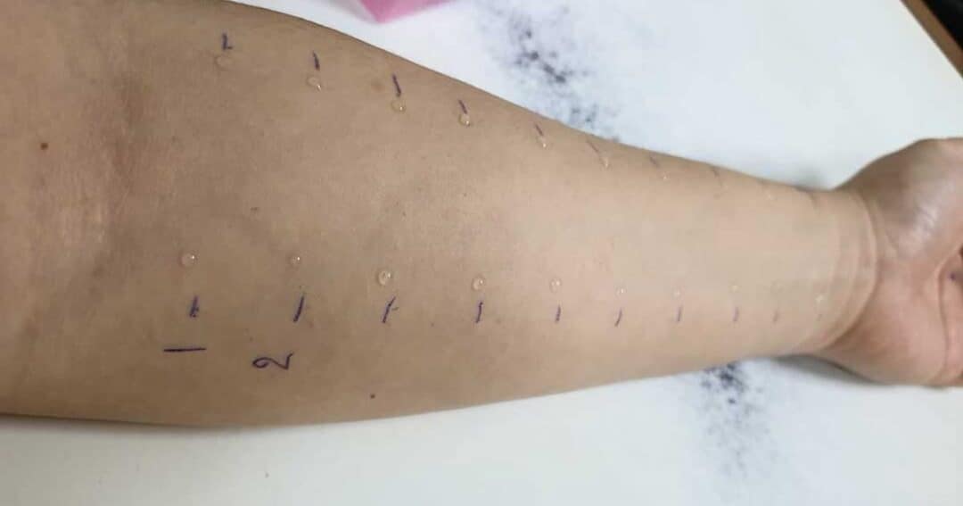 Grass Allergy 5 An arm undergoing an allergy test is shown with various small droplets applied to the skin and markings beside each droplet.