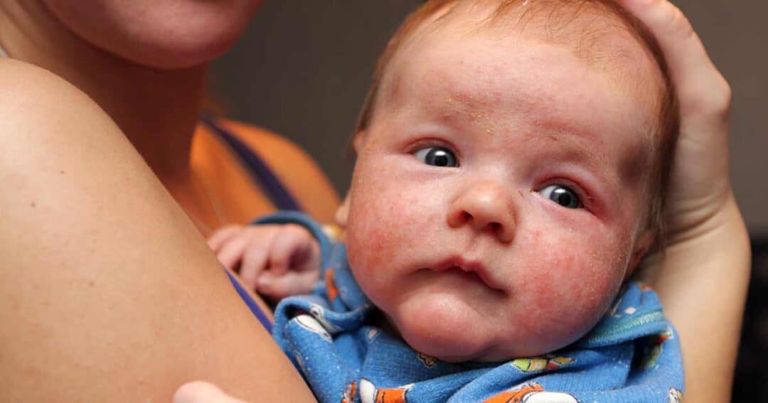 What is Moderate to Severe Eczema? 1 A baby with red eczema patches on its cheeks, wearing a blue onesie adorned with cartoon characters, is being held by an adult. The adult is partially visible in a sleeveless top, gently supporting the baby's head.