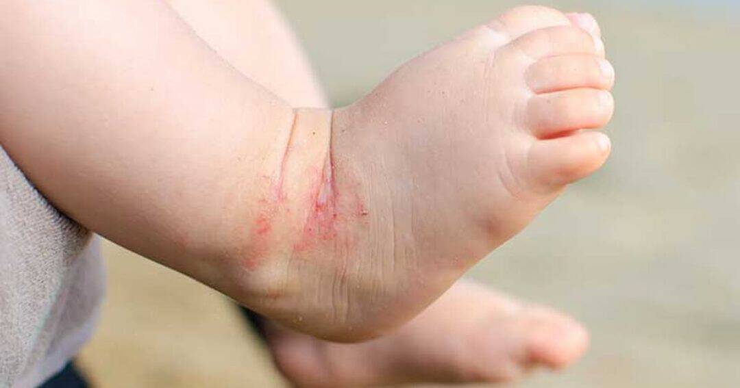 Hives 6 Close-up of a baby's foot with irritated and reddened skin around the ankle, possibly due to eczema or a rash. The background is blurred and neutral, focusing on the foot's condition.