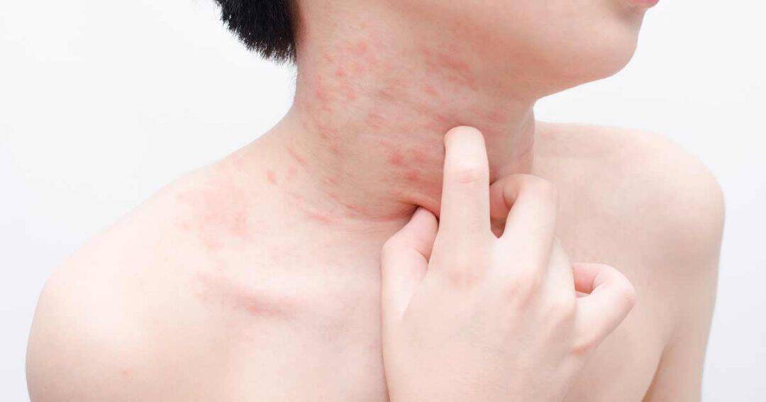 Close-up of a person scratching their neck, which has visible red patches of skin irritation or hives. The plain background highlights the affected area on the neck and shoulder.