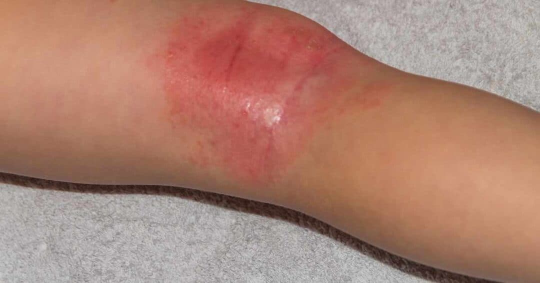 A close-up image of a person’s knee shows a large, red, inflamed rash, likely due to contact dermatitis. The skin appears irritated and possibly swollen, suggesting an allergic reaction. The background is a soft, neutral color, likely a towel or fabric.