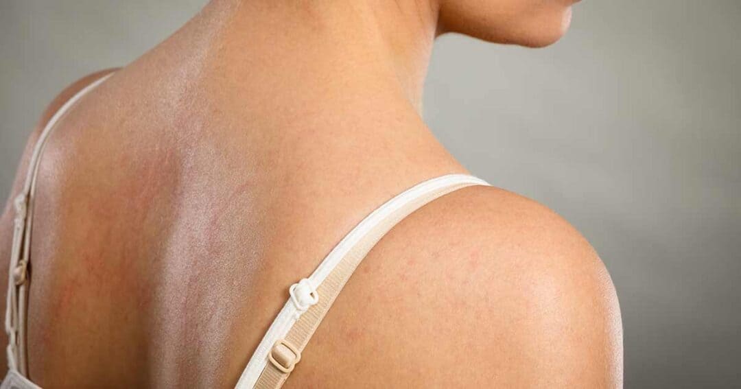 the back of a woman who has issues with chronic hives
