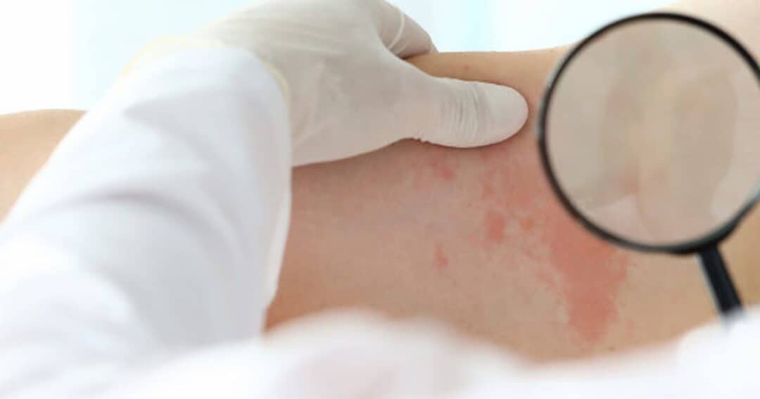 What is Moderate to Severe Eczema? 9 A person with light skin is being examined for skin irritation or rash using a magnifying glass. A gloved hand gently holds the area to inspect the red patches.