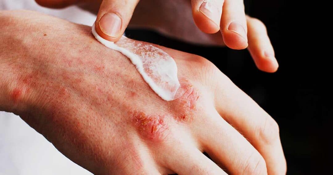 What is Moderate to Severe Eczema? 3 A hand with red, irritated skin from eczema is being treated with a dollop of white cream. Two fingers gently apply the soothing cream, focusing on the affected areas. The dark background highlights the careful application and emphasizes relief for eczema-prone skin.