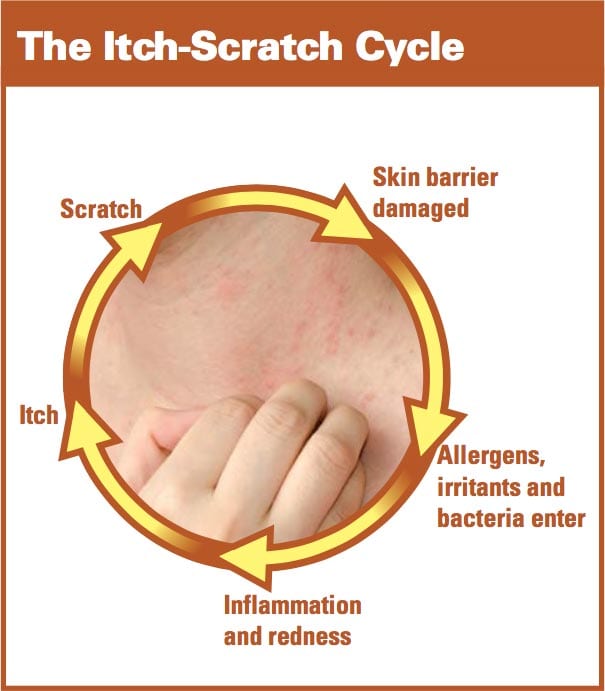 What is Moderate to Severe Eczema? 7 Diagram titled "The Itch-Scratch Cycle" showing a circular process: 1) Skin barrier damaged, 2) Allergens, irritants, and bacteria enter, 3) Inflammation and redness, 4) Itch, 5) Scratch. A hand scratches inflamed skin at the center.