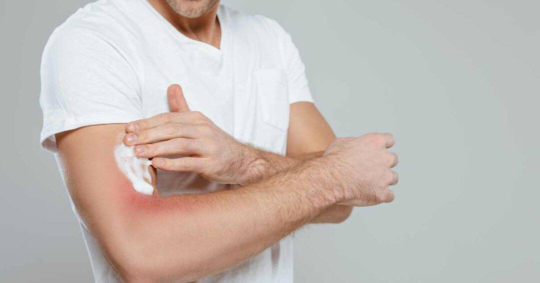 What is Moderate to Severe Eczema? 4 A person applies a white cream to their elbow, irritated by eczema. They are wearing a white t-shirt against a plain gray background.