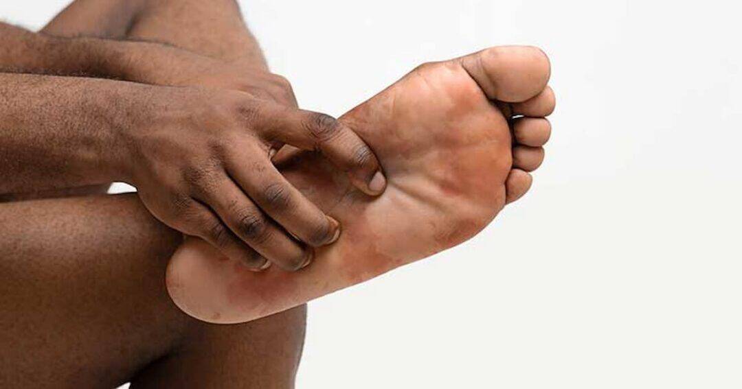 Hives 3 A person seated, holding and examining their bare foot. The focus is on the sole, with the other hand touching the arch, suggesting inspection or discomfort. The background is plain and neutral.