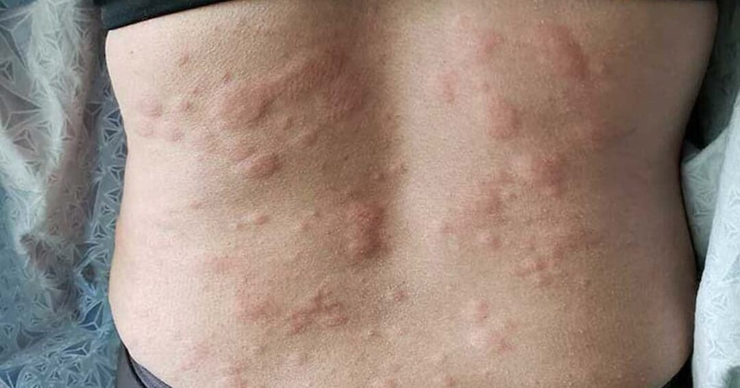 Hives 7 Close-up of a person's back showing a rash with numerous reddish bumps distributed across the skin. The person is wearing a black top, and the rest of the background is out of focus.