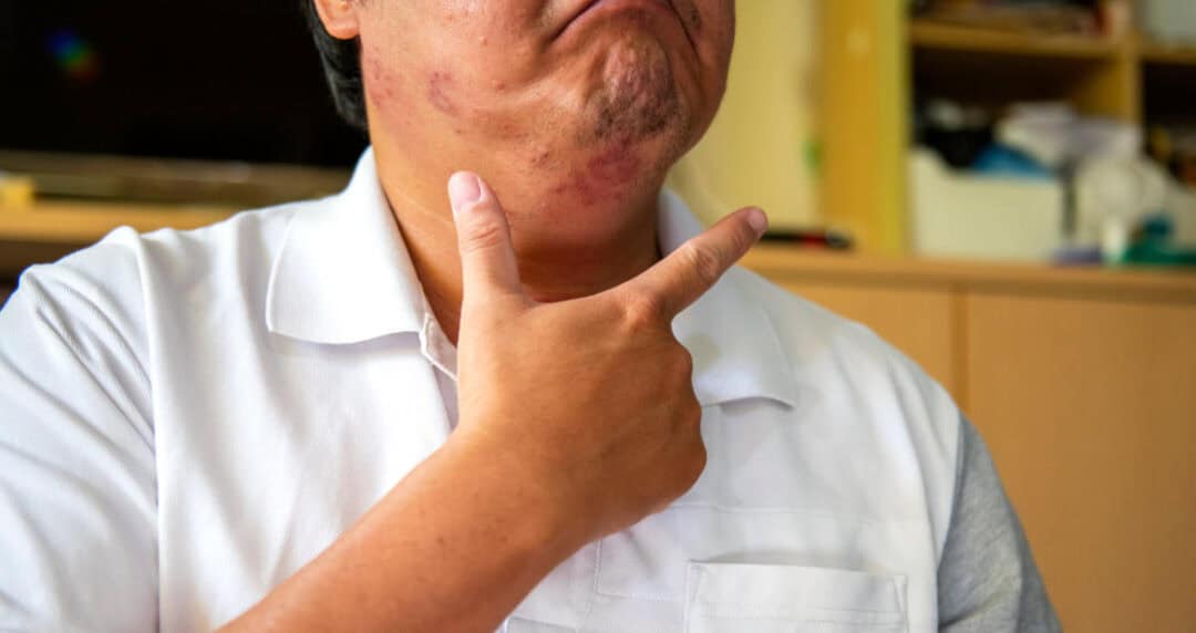A person pointing to their chin, which shows visible hives. They are wearing a white shirt, and part of a room with shelves is visible in the background.
