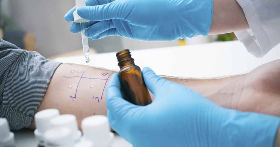A healthcare professional wearing blue gloves performs an allergy skin test on a person's forearm using a dropper and a brown bottle. The arm has numbered sections marked with pen, each containing a small droplet of liquid.