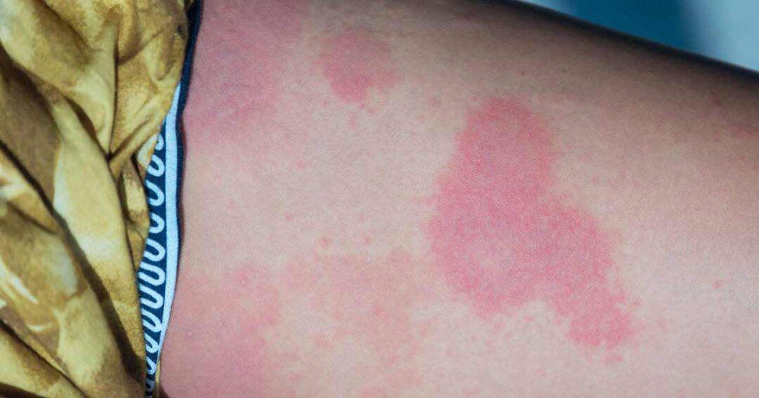 red raised patches of Urticaria on womans leg
