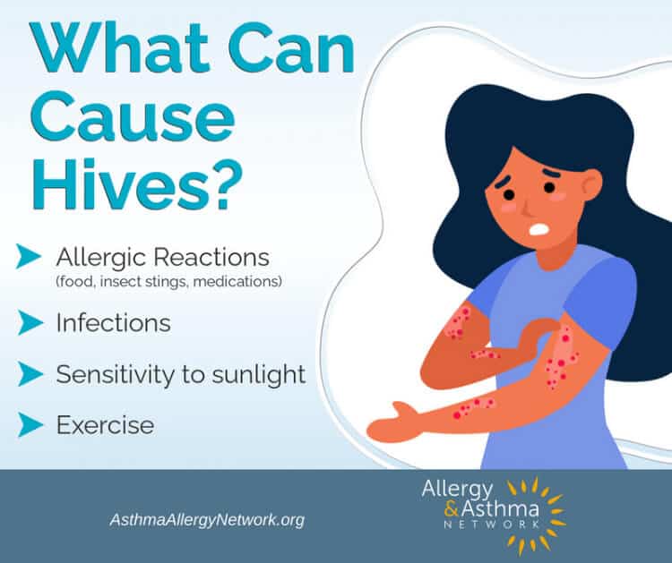 Hives 4 Illustration of a worried woman with red hives on her arms. Text reads "What Can Cause Hives?" with a list: allergic reactions, infections, sensitivity to sunlight, and exercise. Allergy & Asthma Network logo is at the bottom.