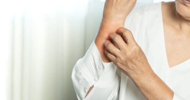 A person in a white shirt scratches their itchy, eczema-ridden forearm, which appears red and irritated. The focus is on their arm and hand against a blurred light background.