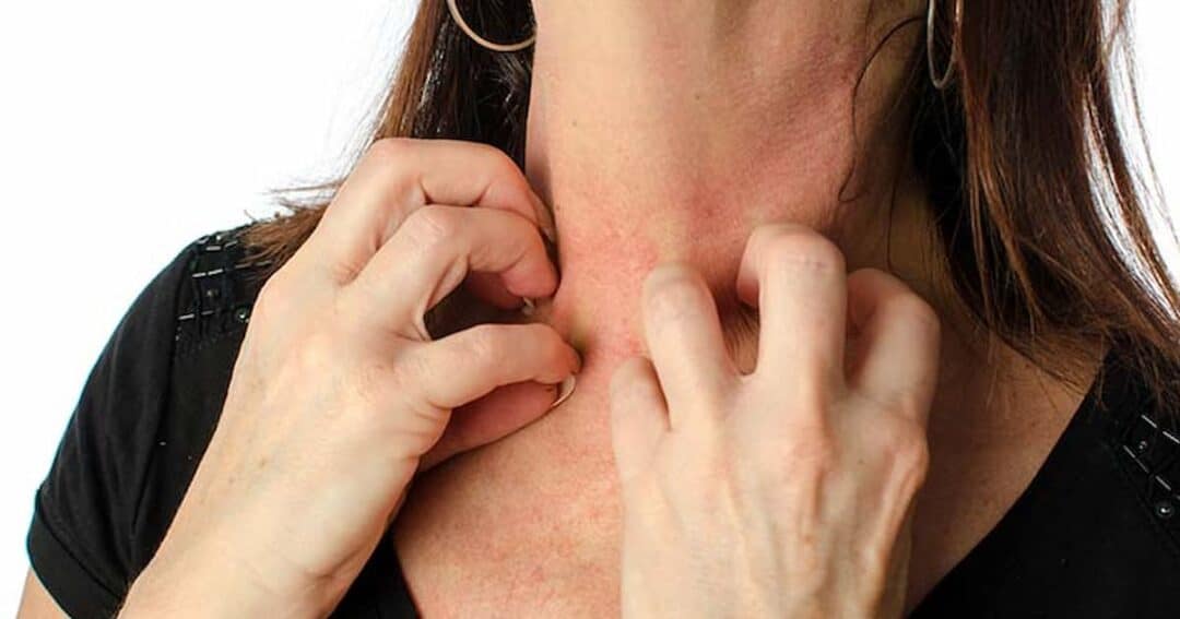 What is Moderate to Severe Eczema? 5 A person scratching their neck with both hands. The skin appears red and irritated. They are wearing a black shirt and have long brown hair. Only the neck and hands are visible.