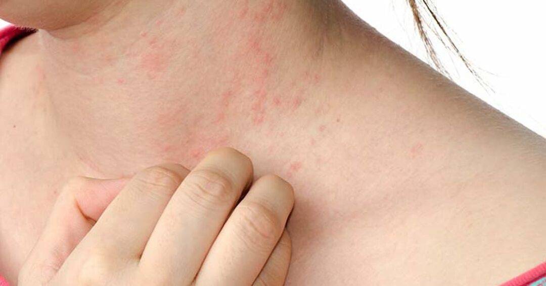 Hives 2 close up of a woman itching the bumbs on her neck