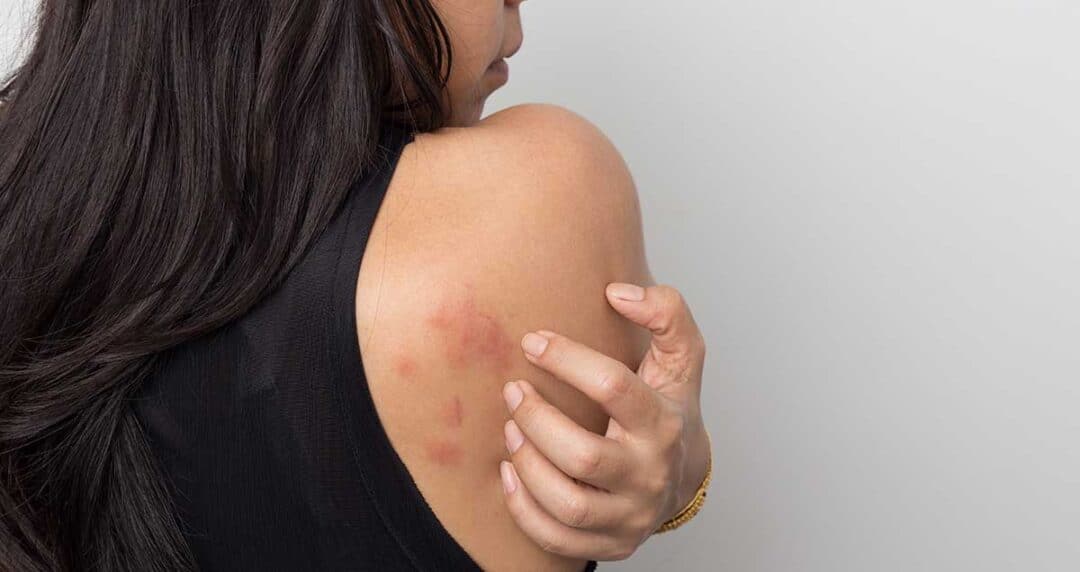 Hives 9 A person with long dark hair is shown from the side, wearing a black sleeveless top. They are scratching a patch of red, irritated skin on their upper arm.